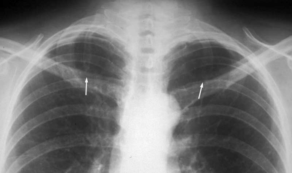 Vratno rebro (cervikalno rebro) | Bambino.si - Portal za nosečnice in ...