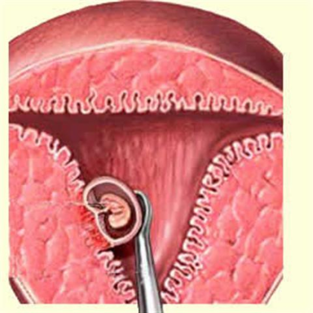 Чистка эндометрия при эндометрии матки. Выскабливание слизистой оболочки матки. Выскабливание плацентарной полипа. Выскабливание эндометрия. Выскабливание полости матки беременности.