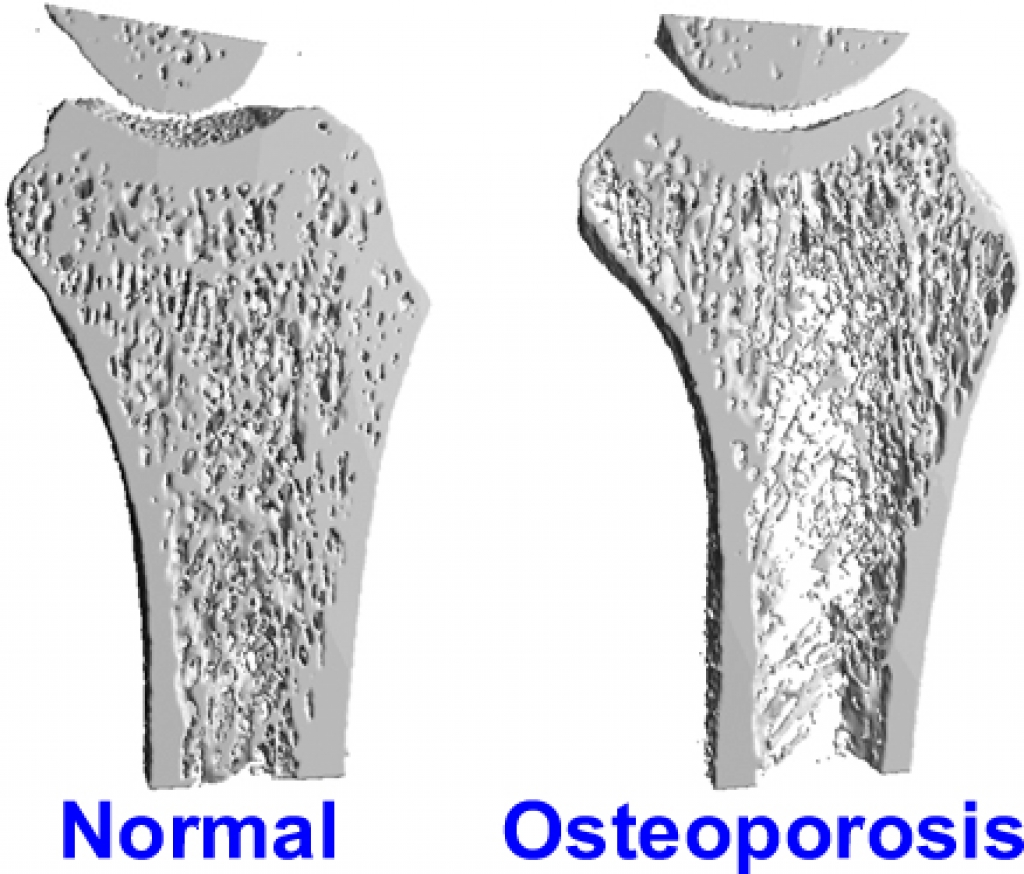 Плотный увеличиваться. Пористость костей. Остеопороз. Увеличение плотности костей. Истончение костной ткани.