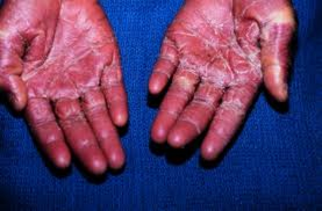 Sindrom toksičnega šoka Bambino.si Portal za nosečnice in dojenčke